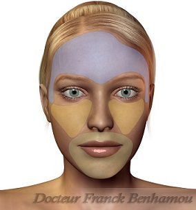 Zones d’injection de PRP pour le visage