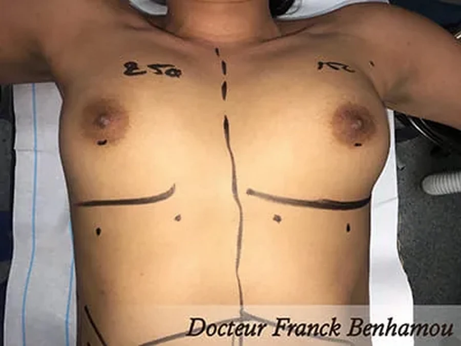 Lipofilling seins