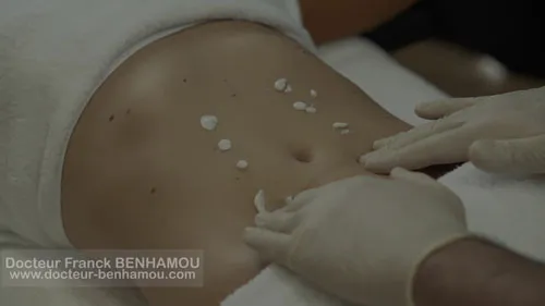 Massage après une lipoaspiration 1