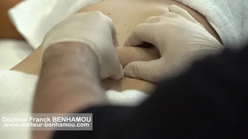 Massage après lipoaspiration 20