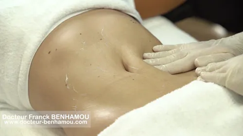 Massage après lipoaspiration 26