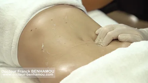 Massage après lipoaspiration 30