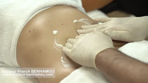 Massage apres lipoaspiration 5