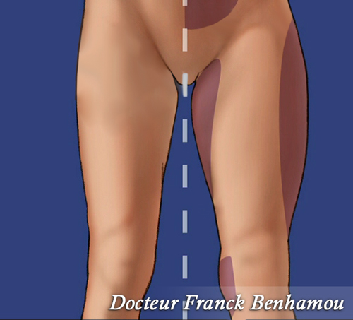 Zone de lipoaspiration ventre cuisse