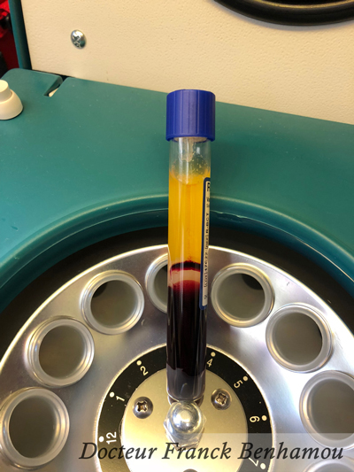 PRP photo après centrifugation