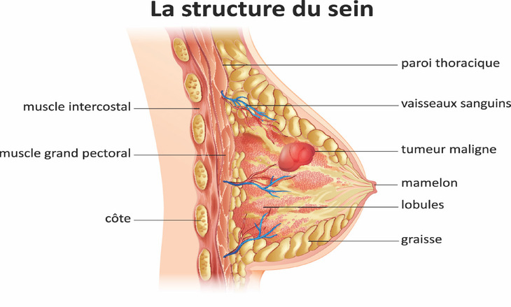 Reconstruction mammaire par injection de graisse