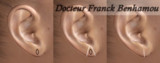 Réparation d'un lobe d'oreille fendu