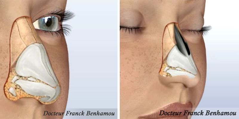 Schéma rhinoplastie