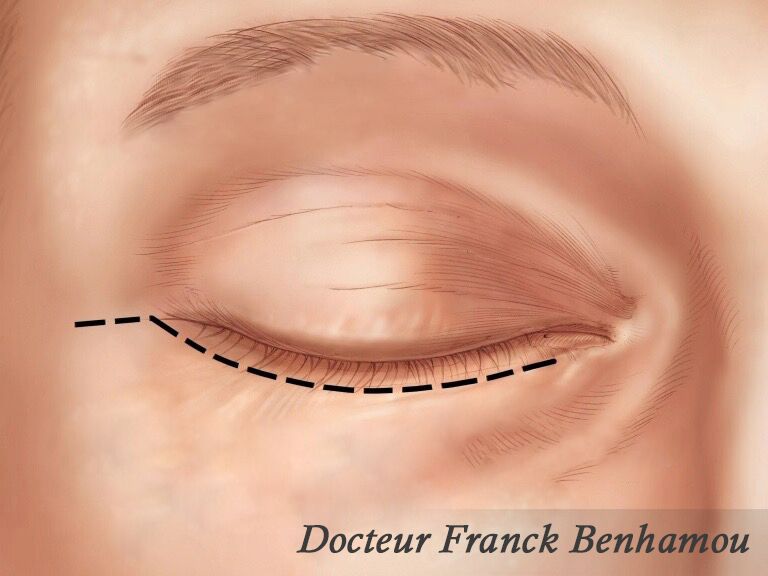 Incision blépharoplastie inférieure