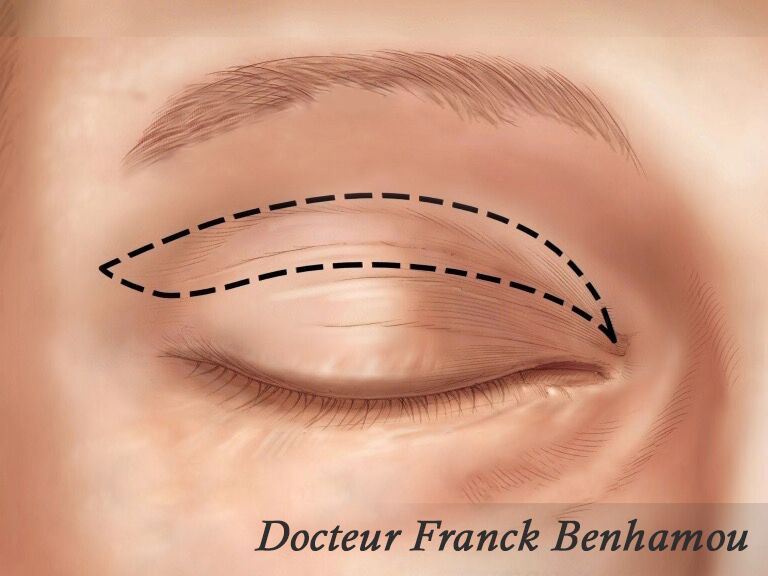 Incision blépharoplastie supérieure