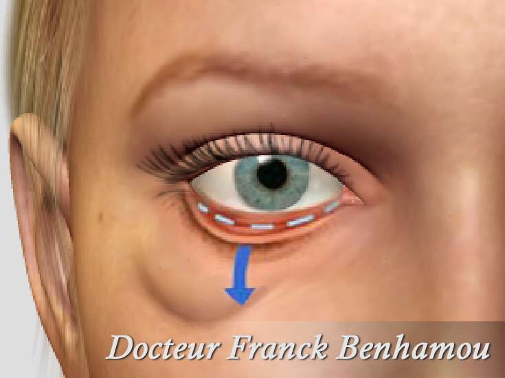 Blépharoplastie inférieure incision conjonctival