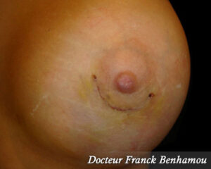 Cicatrice aréolaire après une augmentation mammaire jour 10