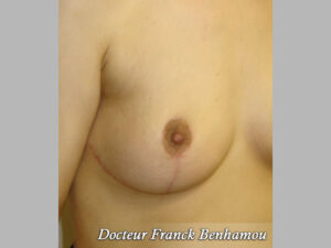 Cicatrice en T jour 90