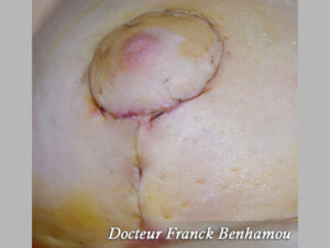 Cicatrice en T jour 1