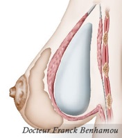 implant mammaire derrière le muscle