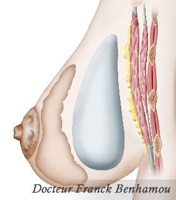 implant mammaire devant du muscle