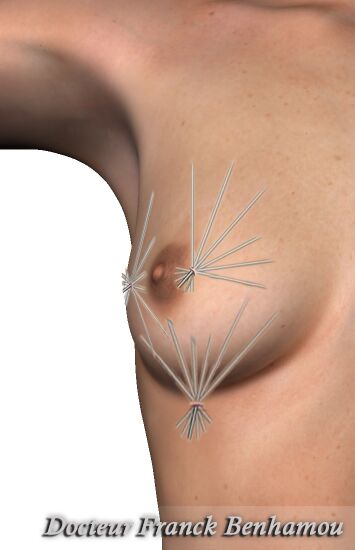 Lipofilling des seins technique d'injection