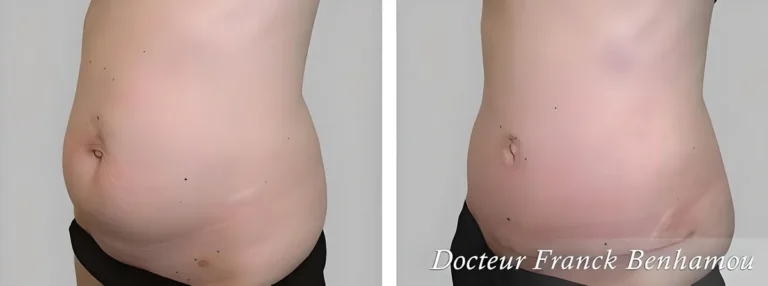 Photos avant après abdominoplastie 10