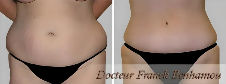 Photos avant après abdominoplastie 9