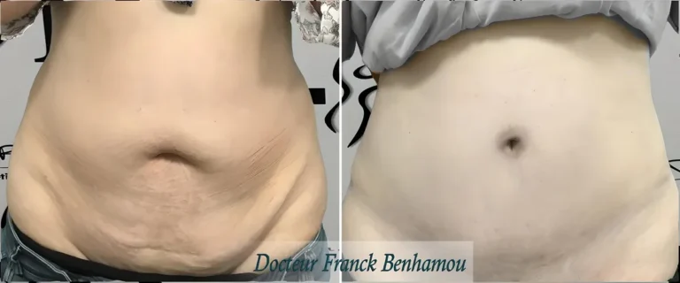 Photo avant/après abdominoplastie