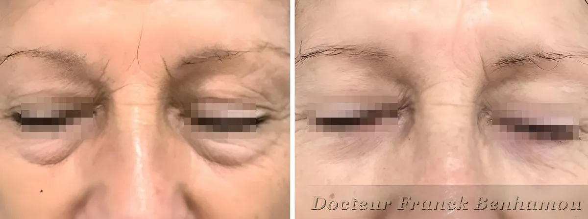 Photo avant/après blépharoplastie