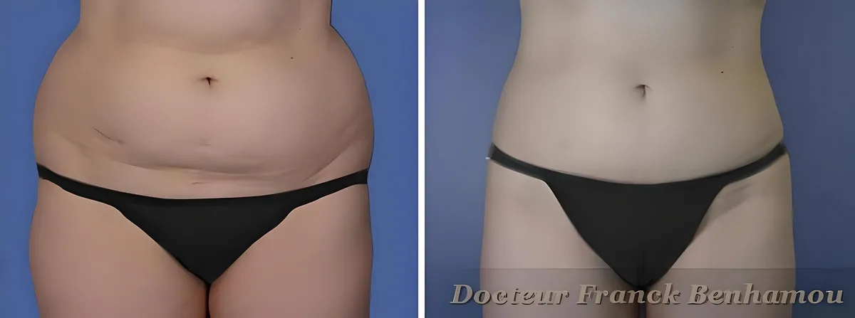 Photos avant après lipoaspiration 3