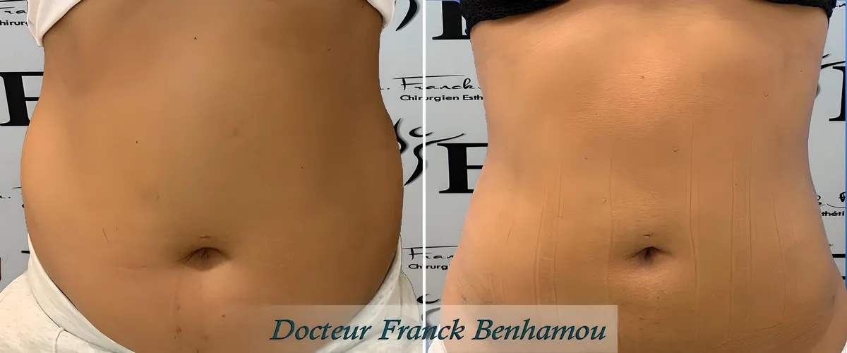 Photo avant/après lipoaspiration abdominal