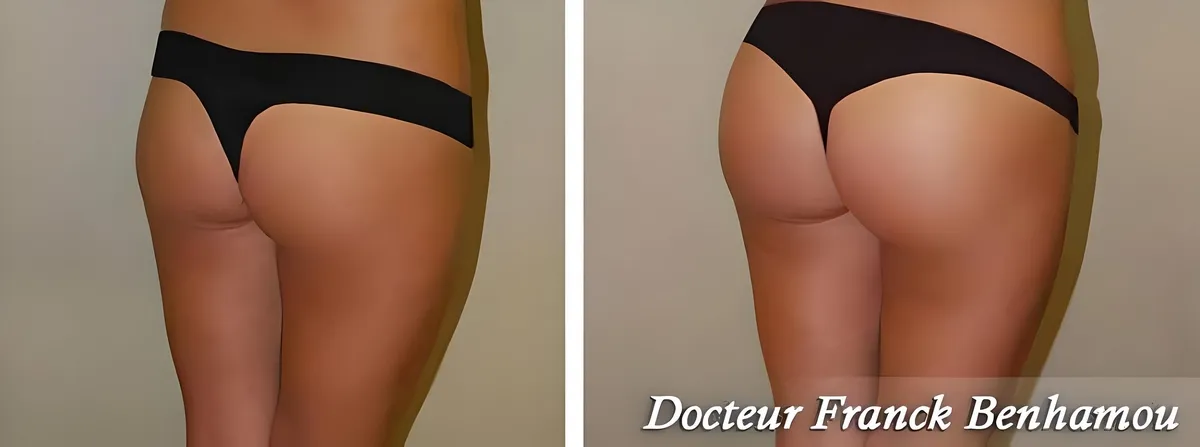 Photos avant après lipofilling des fesses