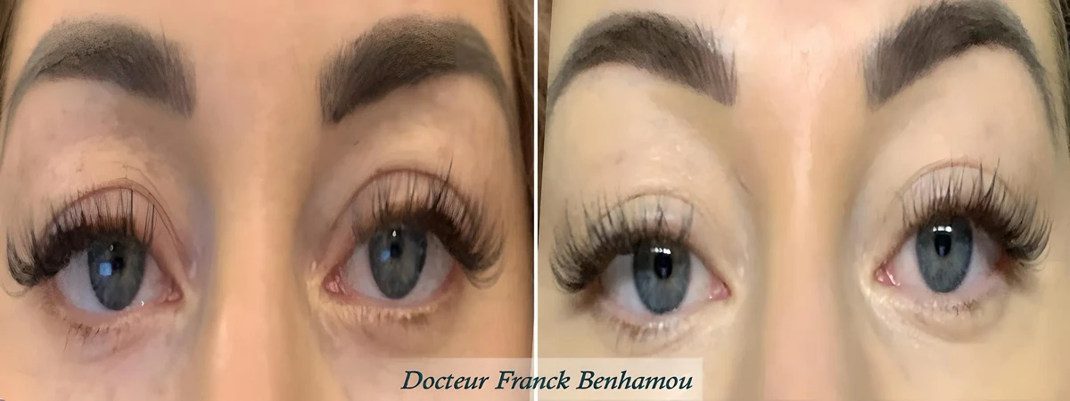 Photos avant/après blépharoplastie médicale