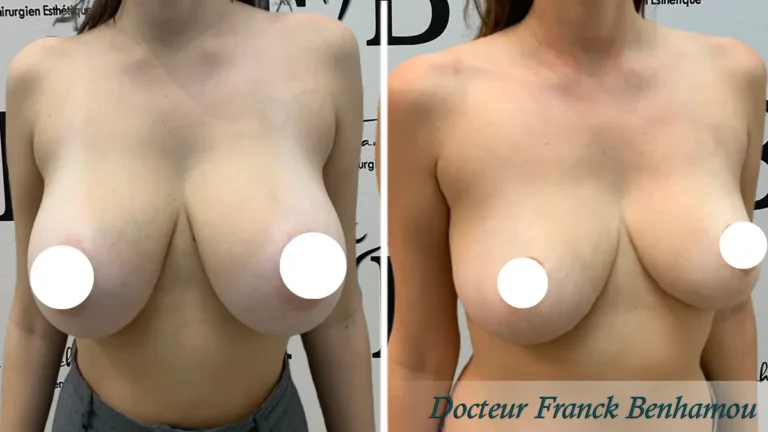Photo avant après réduction mammaire