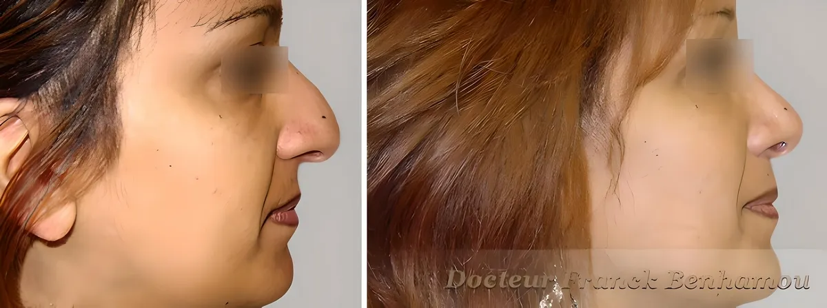 Photo avant/après rhinoplastie