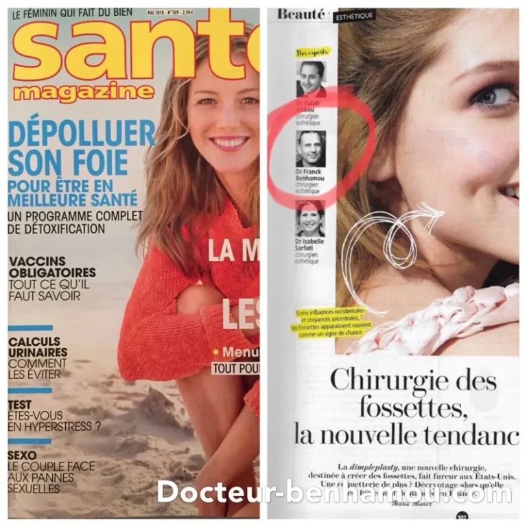 SANTE MAGAZINE, chirurgie des fossettes, la nouvelle tendance