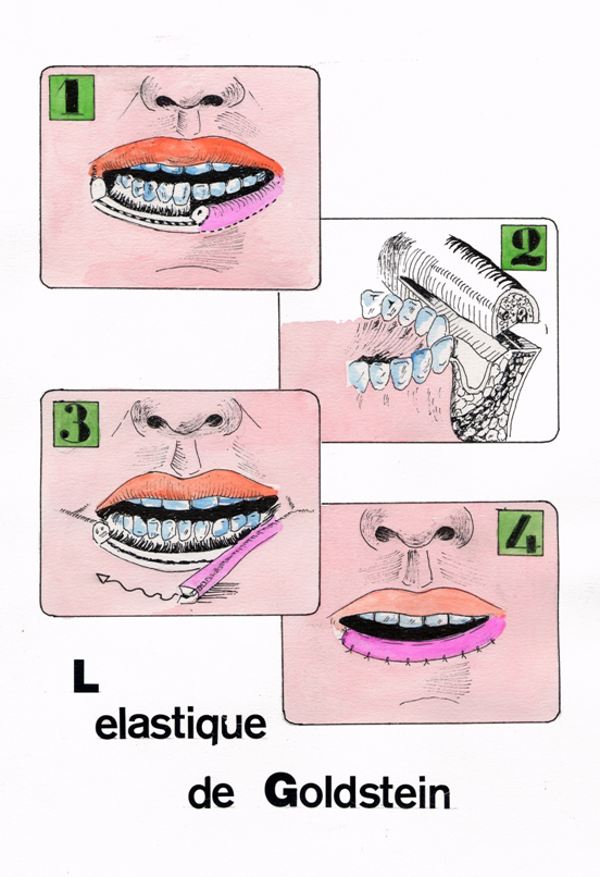 L'élastique de Goldstein