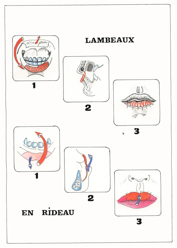 Lambeaux en rideau