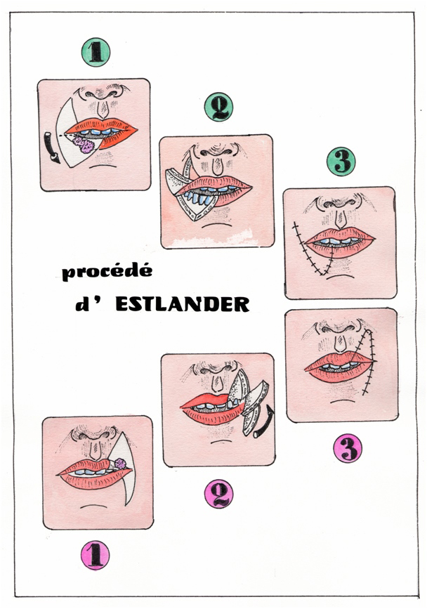 Procédé d'ESTLANDER