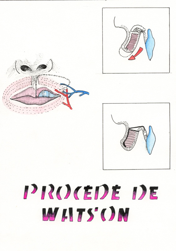 Procédé de Watson