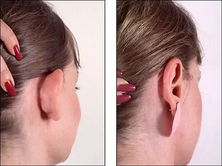 L'otoplastie est-elle remboursée?