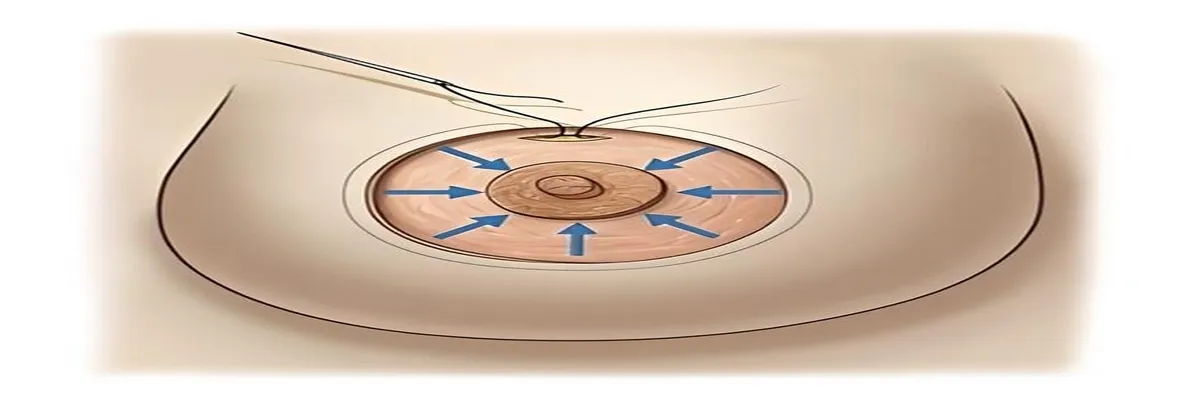 Qu’est-ce qu’un round block en chirurgie esthétique?