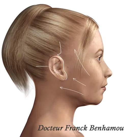Schéma lifting du visage
