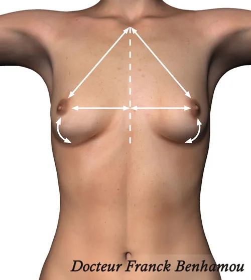 Mesures thorax avant pose implant mammaire