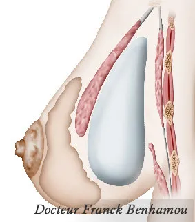Schéma prothèse mammaire bi plan