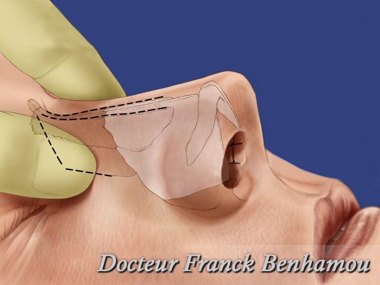 Schéma rhinoplastie