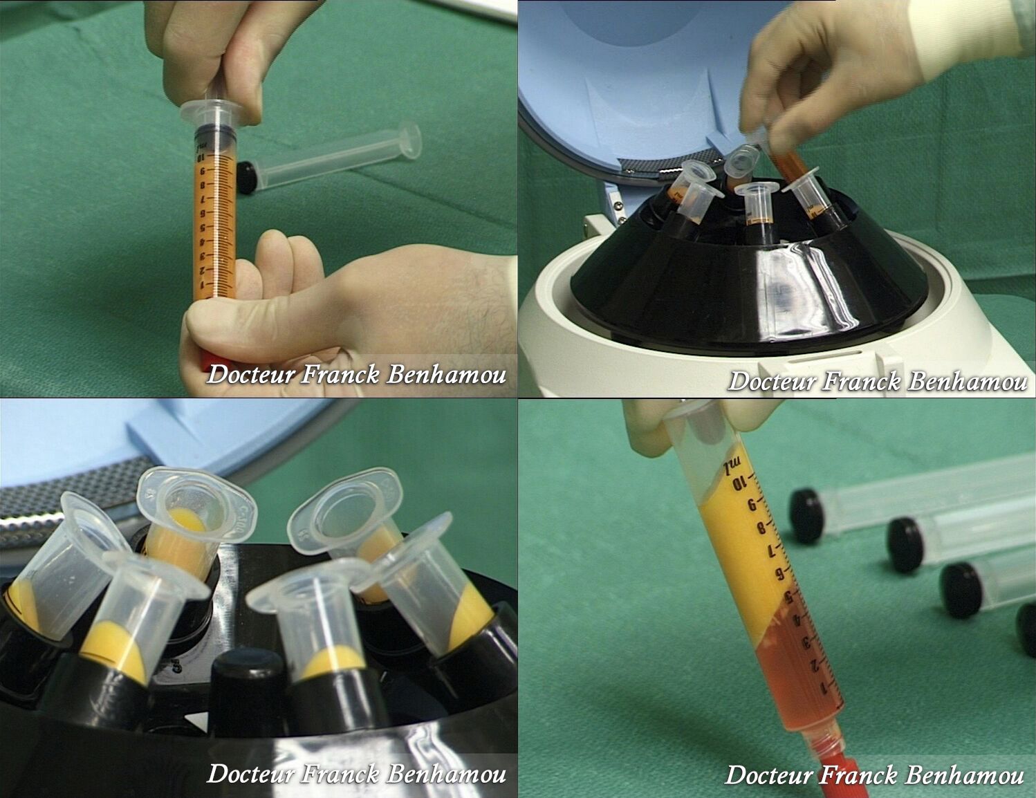 Technique d' injection de graisse dans les fesses