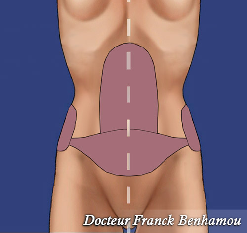 Zone de lipoaspiration pour lipofilling des seins