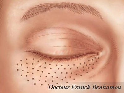 plexr blépharoplastie inférieure médicale