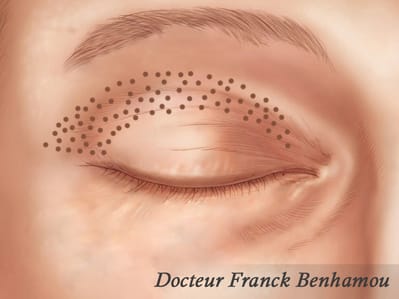 plexr blépharoplastie supérieure médicale