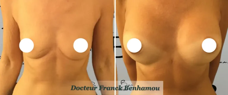 Photo avant après augmentation mammaire