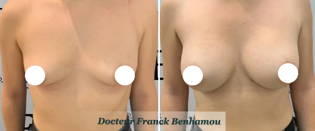 Photo avant après augmentation mammaire