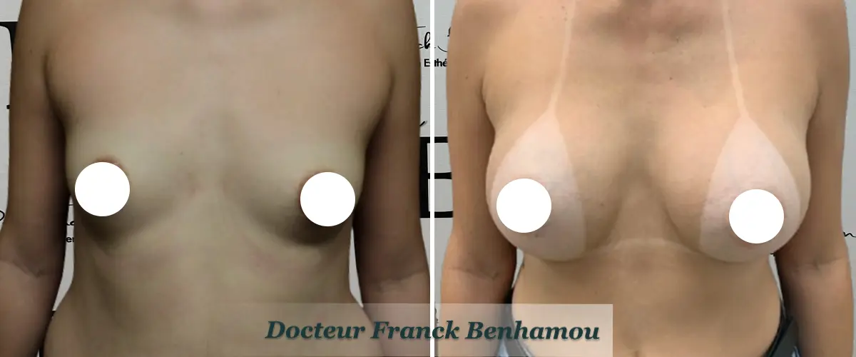 Photo avant après augmentation mammaire