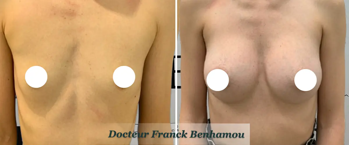 Photo avant après augmentation mammaire